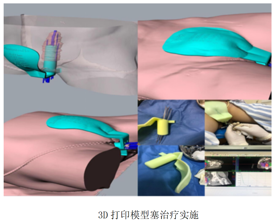 3D打印技术为宫颈癌患者带来福音——甘肃省肿瘤医院放疗科完成省科技厅重大研发项目《3D打印个体化施源器应用在宫颈癌近距离治疗中的研究》